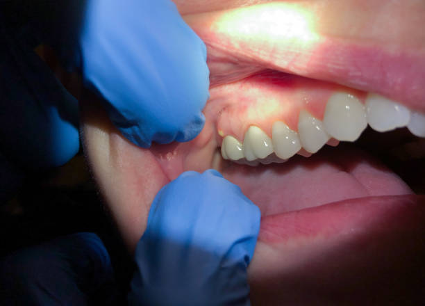 Best Emergency Treatment for Toothache in Pemberton Heights, NJ